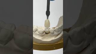 Premolar Mini Syton Implant lsk121shorts dentistry teeth [upl. by Remle]