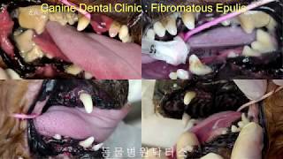 FIBROMATOUS EPULIS 치은종 [upl. by Kimberly]