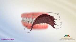 Orthodontic Retainers Hawley Clear and Permanent [upl. by Cleve]