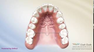 Orthodontic Appliance  TPA Trans Palatal Arch [upl. by Atteroc691]