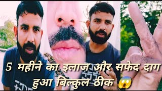 Vitiligo Vlogger 5 महीने में मेरा सफेद दाग हो गया बिल्कुल ठीक जाने कैसे [upl. by Sig]