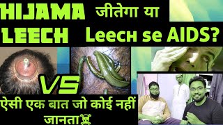 Hijama Therapy Vs Leech Therapy  कौन न है सबका बाप कौन है सबसे ज्यादा effective [upl. by Araek]