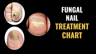 Fungal Nail Treatment Options Chart [upl. by Akirahs]