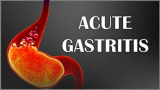 Acute Gastritis  Signs amp Symptoms Causes Pathogenesis Complications Diagnosis amp Treatment [upl. by Alamac]