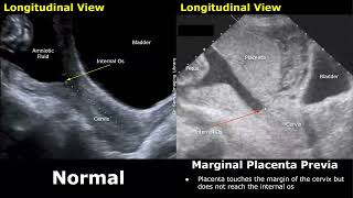 Obstetric Ultrasound Normal Pregnancy Vs Placenta Previa  LowLying Marginal Partial Complete [upl. by Dirfliw252]