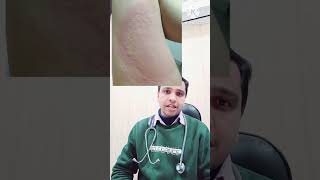 पित्ती उछलना urticaria Homeopathic treatment shorts [upl. by Folberth]