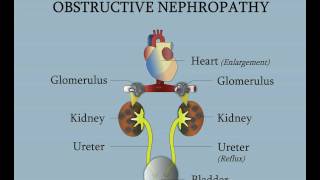 Posterior Urethral Valves  Obstructive Nephropathy [upl. by Ahsetra836]