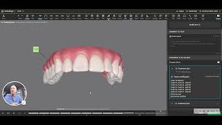 Short Upper Lateral Incisors with Invisalign extrusion not always the answer [upl. by Nebe]