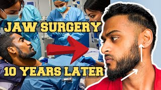 Jaw Underbite Surgery  10 YEARS LATER [upl. by Anilram]