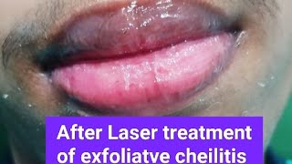 Two cases of exfoliatve cheilitis treated by Laser excellent response [upl. by Greenland]