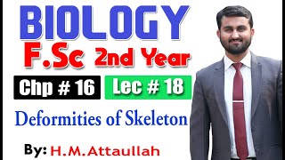 Deformities of skeleton  Chapter 16  2nd year Biology  Lec  18 [upl. by Ahsined352]