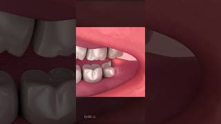 Wisdom Teeth Impaction Explained [upl. by Carpio]