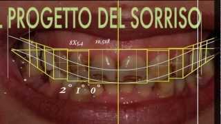 Cambiare laspetto del sorriso con faccette dentali  SMILE DESIGN [upl. by Oirram]