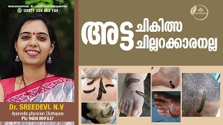 അട്ട ചികിത്സ  Leech Therapy Malayalam  Leech Therapy Benefits  Dr Sreedevi [upl. by Jayme920]