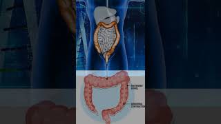 appendix appendicitis pain stomachpain gaspain 24hourspain [upl. by Seligman]