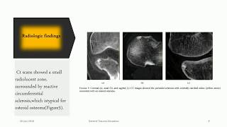 Osteoid Osteoma [upl. by Jehiah]