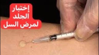 إختبار الجلد لمرض السل Tuberculin Skin Test [upl. by Eirroc]