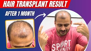 My Hair Transplant 1 Month Update  Shedding Phase After Hair Transplant  Hairmate Clinic Pune [upl. by Enyaw880]