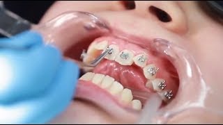 Como se Ponen los Brackets  Instalación de Frenillos Paso a Paso  Ortodoncia [upl. by Ayotnahs395]