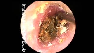 Earwax Removal Extractions By Tweezers and Hook 三个硬菜大放送 外耳道挖耳屎清理 耳垢 耳垢 [upl. by Yunfei]