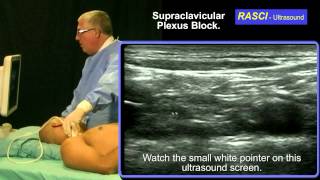 Ultrasound guided Supraclavicular plexus block [upl. by Laehpar]