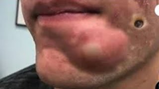 Big Cystic Acne Blackheads Extraction Blackheads amp Milia Whiteheads Removal Pimple Popping  5240 [upl. by Saucy779]