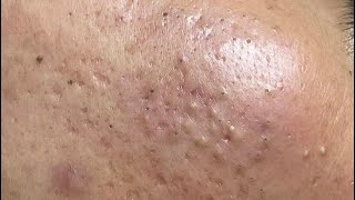 ACNE TREATMENT VU QUYNH MI Blackheads On Boy Face 2024 [upl. by Jon]