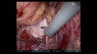 daVinci distal rectal cancer surgery with original audio [upl. by Rigdon]