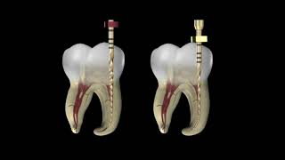 Pulpectomy ⚪️ Step By Step Demonstration 🔵 Baby Blue Pediatric Rotary Endodontic Files [upl. by Narud]