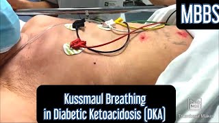 Kussmaul Breathing seen in Diabetic Ketoacidosis DKA mbbs medicine neetpg aiims usmle [upl. by Ultan]