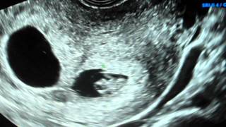 8 week ultrasound TWINS with heartbeats IVF [upl. by Pascha478]