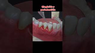 Gingivitis y periodontitis gingivitis periodontitis dolordental viralfypシ parati fyp dental [upl. by Ynohtnacram]