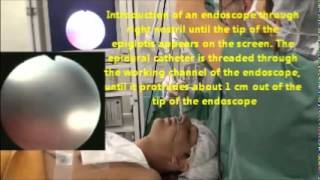 awake nasotracheal 17 maio English subtitles and narration [upl. by Sairacaz]