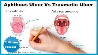 Aphthous ulcerstomatitis Vs Traumatic ulcer [upl. by Linson]