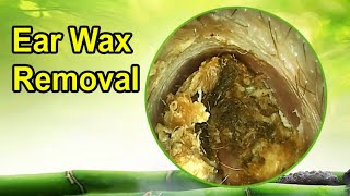 Best relaxing video earwax removal [upl. by Aniwde]