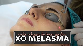 Antes e Depois do meu tratamento de Melasma com laser Spectra NdYAG QSwitched [upl. by Adora]