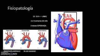 PERSISTENCIA DEL CONDUCTO ARTERIOSO PARTE 1 [upl. by Akirahs403]