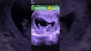 Level 2 ultrasound गर्भवती का महत्वपूर्ण अल्ट्रासाउंड [upl. by Tanney]