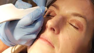 Non surgical blepharoplasty with PLEXR [upl. by Nirred]