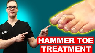 Claw Toe amp Hammer Toe Treatment Straighten Your Toes NO SURGERY [upl. by Akihdar405]