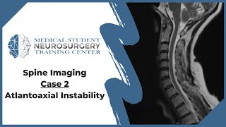 Spine Imaging Case 2 Atlantoaxial Instability [upl. by Narak]