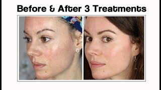 Microneedling Update Before amp After 3 Treatments [upl. by Boswell973]