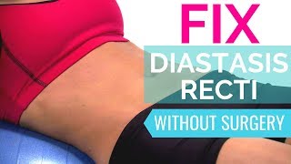 How To Fix Diastasis Recti  Heal Diastasis Recti Naturally Without Surgery [upl. by Assennev435]