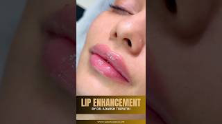 Amazing Plump Lips With Lip Fillers  Sarayu Clinics fillers [upl. by Miranda]