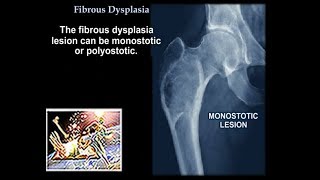 Fibrous Dysplasia  Everything You Need To Know  Dr Nabil Ebraheim [upl. by Darce577]