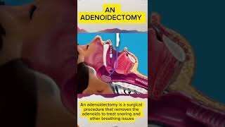 quotAdenoidectomy Explained How Removing Adenoids Can Help Stop Snoring and Improve Breathingquot [upl. by Rupert210]