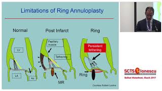 Mitral Regurgitation Stephen Little MD [upl. by Raeann276]