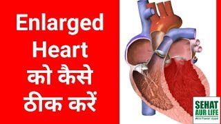 Enlarged Heart को कैसे ठीक करें In Hindi [upl. by Attelrahs806]