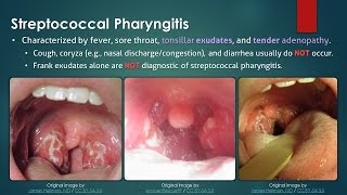 Streptococcal Pharyngitis [upl. by Aicenad116]