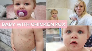 Day in the Life  Baby with Chicken Pox [upl. by Dlonyer]